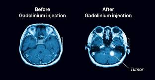 Gadolinium MRI sib piv tus neeg saib xyuas